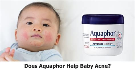 Does aquaphor help cradle cap. Things To Know About Does aquaphor help cradle cap. 